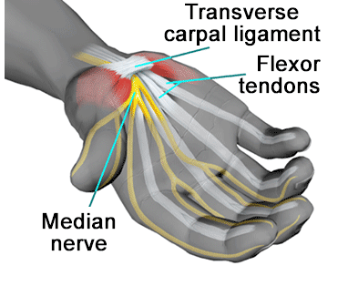 What Carpal Tunnel Is