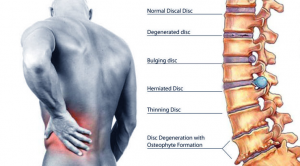 Back Pain – Natural Results Chiropractic