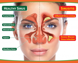 natural-results-chiropractic-sinusitis