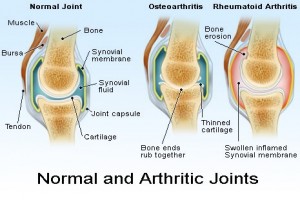 There are two major types of arthritis—osteoarthritis and rheumatoid arthritis.