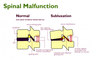 subluxation2